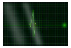 Electrocardiograms Thumbnail