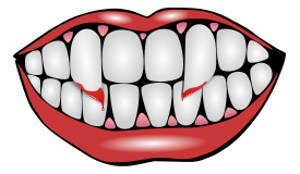 Vampire Teeth Thumbnail
