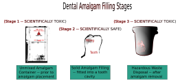 Dental Amalgam Filling Stages